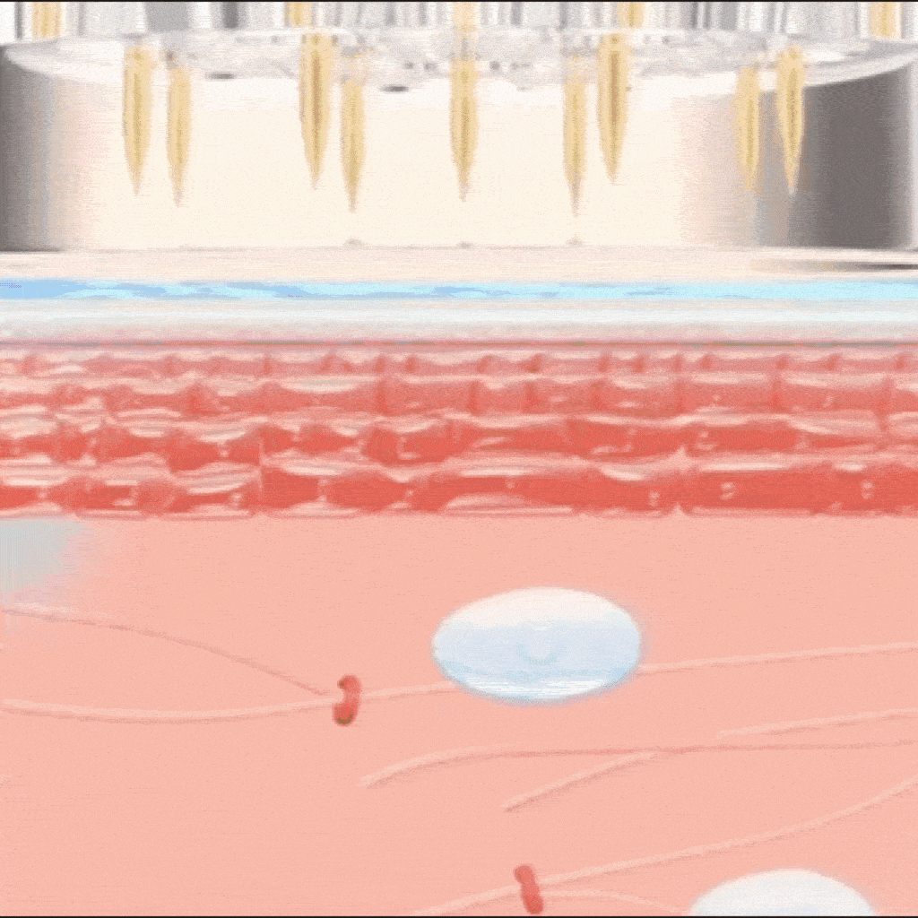 Microinfusión Profunda