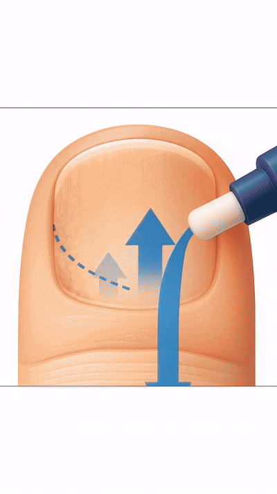 Penetra la uña engrosada